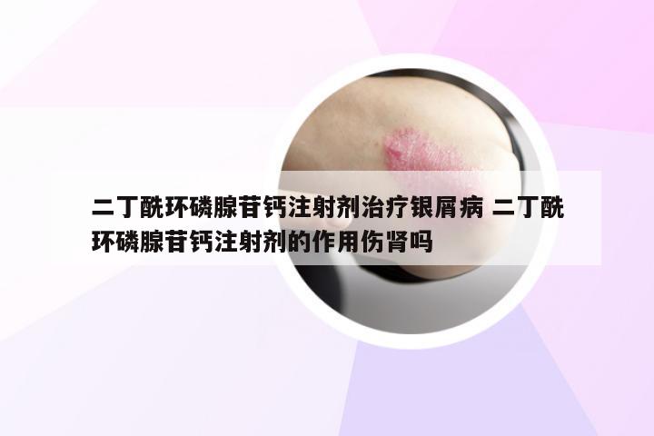 二丁酰环磷腺苷钙注射剂治疗银屑病 二丁酰环磷腺苷钙注射剂的作用伤肾吗