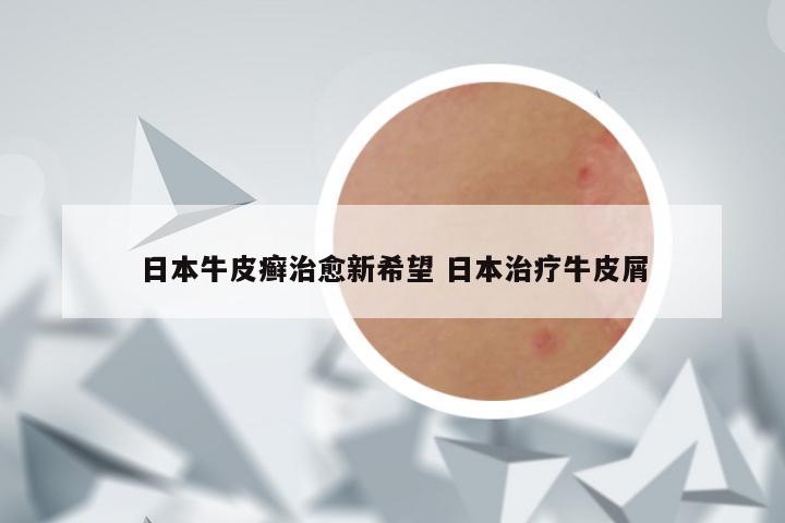 日本牛皮癣治愈新希望 日本治疗牛皮屑
