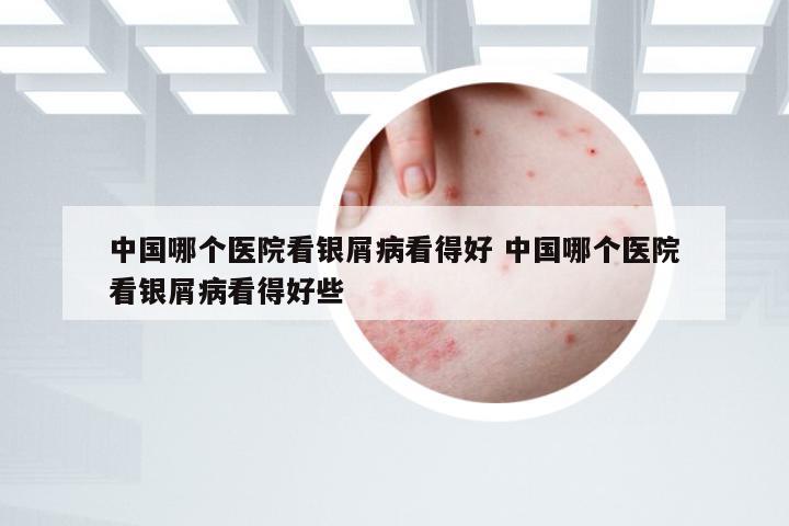 中国哪个医院看银屑病看得好 中国哪个医院看银屑病看得好些