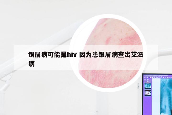 银屑病可能是hiv 因为患银屑病查出艾滋病