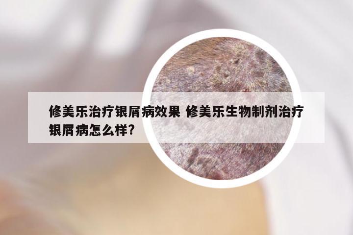 修美乐治疗银屑病效果 修美乐生物制剂治疗银屑病怎么样?