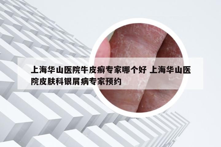 上海华山医院牛皮癣专家哪个好 上海华山医院皮肤科银屑病专家预约