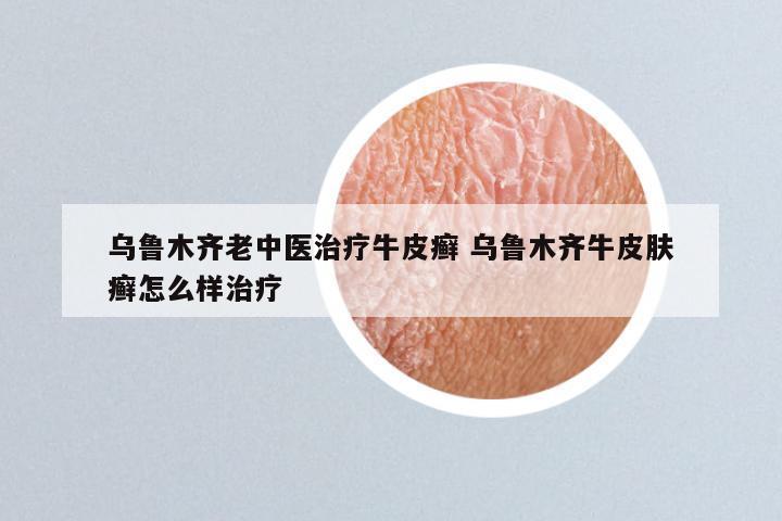 乌鲁木齐老中医治疗牛皮癣 乌鲁木齐牛皮肤癣怎么样治疗