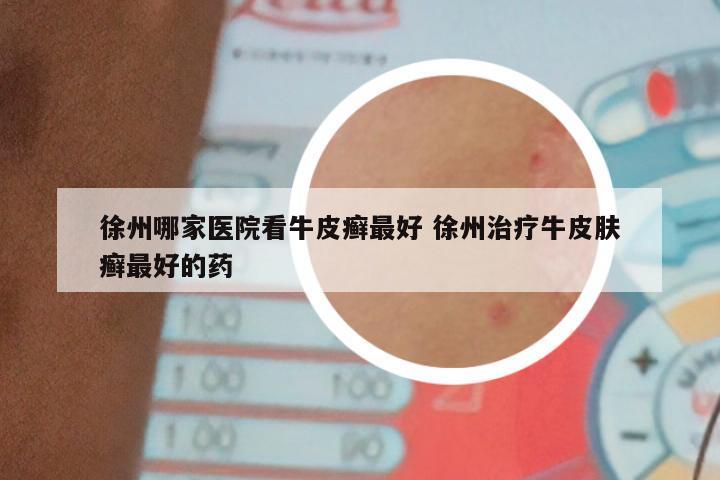 徐州哪家医院看牛皮癣最好 徐州治疗牛皮肤癣最好的药