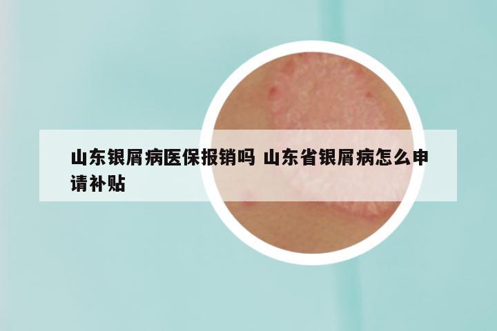 山东银屑病医保报销吗 山东省银屑病怎么申请补贴