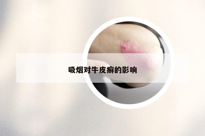 吸烟对牛皮癣的影响