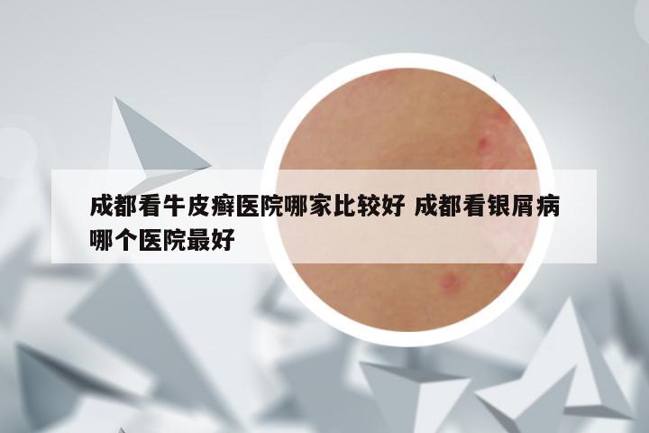 成都看牛皮癣医院哪家比较好 成都看银屑病哪个医院最好