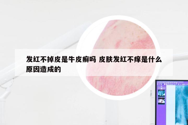 发红不掉皮是牛皮癣吗 皮肤发红不痒是什么原因造成的