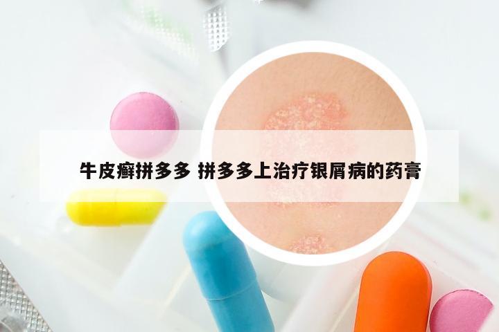 牛皮癣拼多多 拼多多上治疗银屑病的药膏