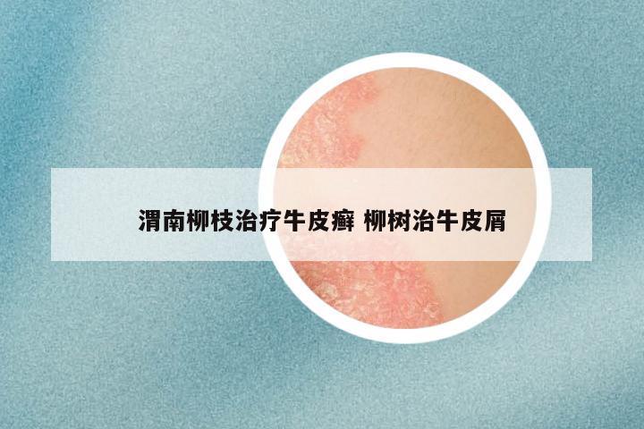 渭南柳枝治疗牛皮癣 柳树治牛皮屑