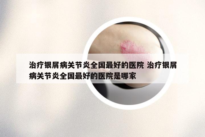 治疗银屑病关节炎全国最好的医院 治疗银屑病关节炎全国最好的医院是哪家