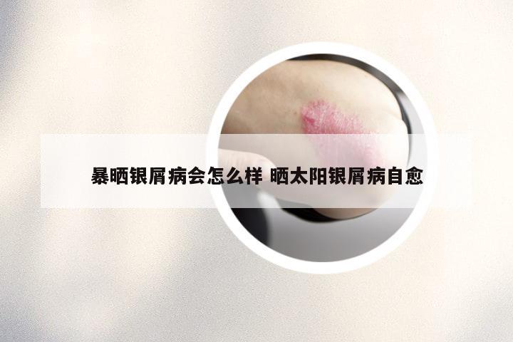 暴晒银屑病会怎么样 晒太阳银屑病自愈