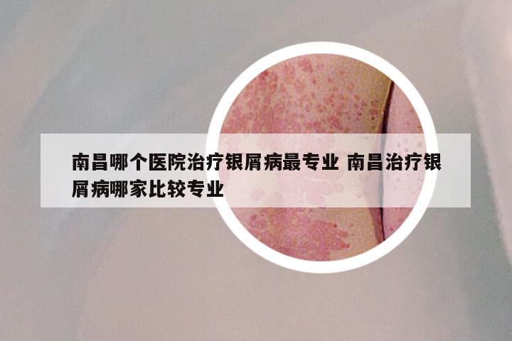 南昌哪个医院治疗银屑病最专业 南昌治疗银屑病哪家比较专业