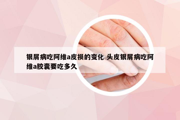 银屑病吃阿维a皮损的变化 头皮银屑病吃阿维a胶囊要吃多久