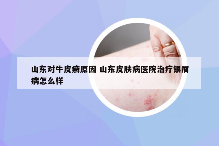 山东对牛皮癣原因 山东皮肤病医院治疗银屑病怎么样