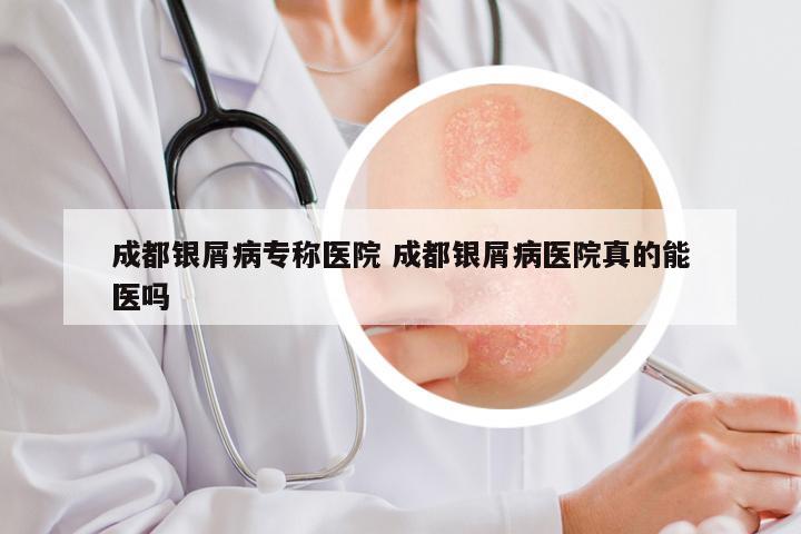 成都银屑病专称医院 成都银屑病医院真的能医吗