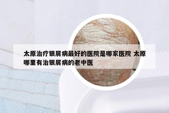 太原治疗银屑病最好的医院是哪家医院 太原哪里有治银屑病的老中医