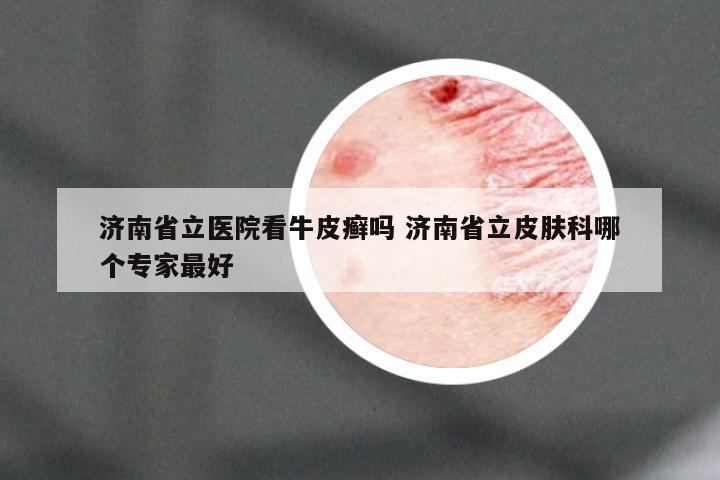 济南省立医院看牛皮癣吗 济南省立皮肤科哪个专家最好