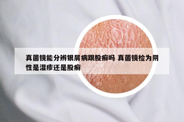 真菌镜能分辨银屑病跟股癣吗 真菌镜检为阴性是湿疹还是股癣