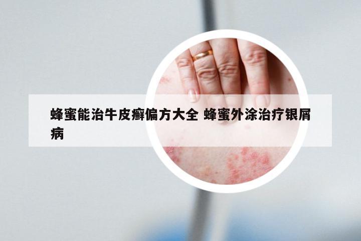 蜂蜜能治牛皮癣偏方大全 蜂蜜外涂治疗银屑病