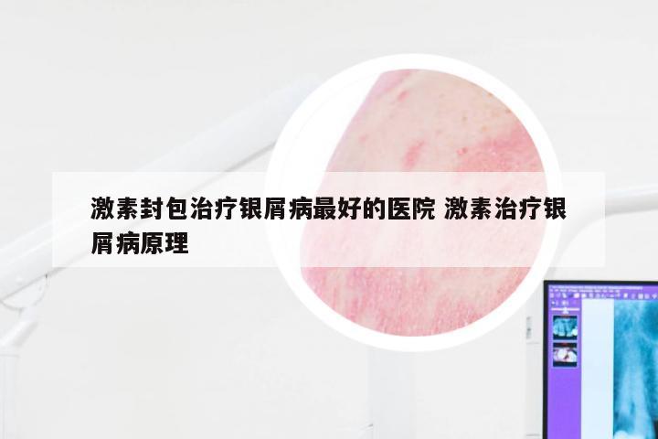 激素封包治疗银屑病最好的医院 激素治疗银屑病原理