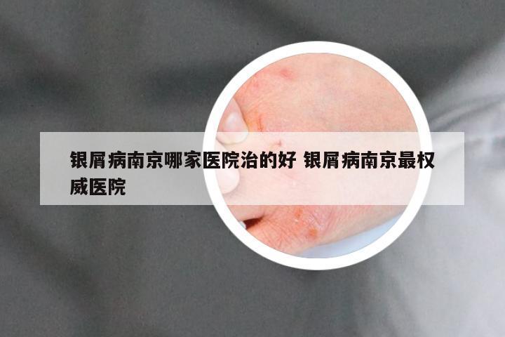 银屑病南京哪家医院治的好 银屑病南京最权威医院