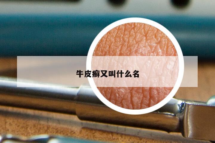 牛皮癣又叫什么名