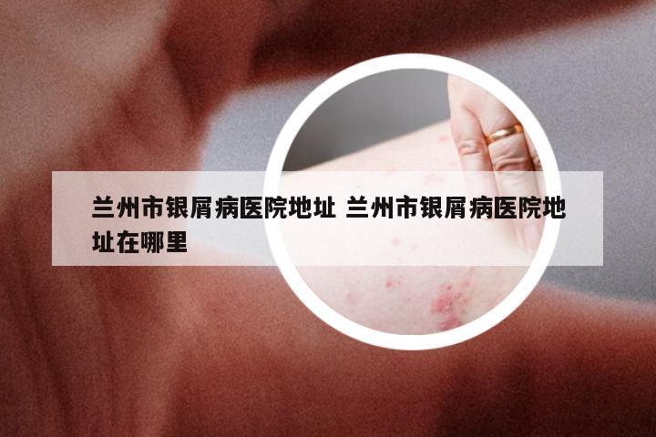 兰州市银屑病医院地址 兰州市银屑病医院地址在哪里