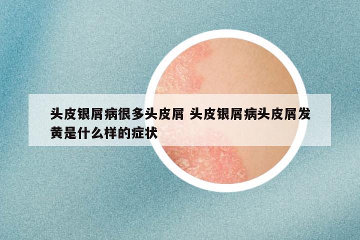 头皮银屑病很多头皮屑 头皮银屑病头皮屑发黄是什么样的症状