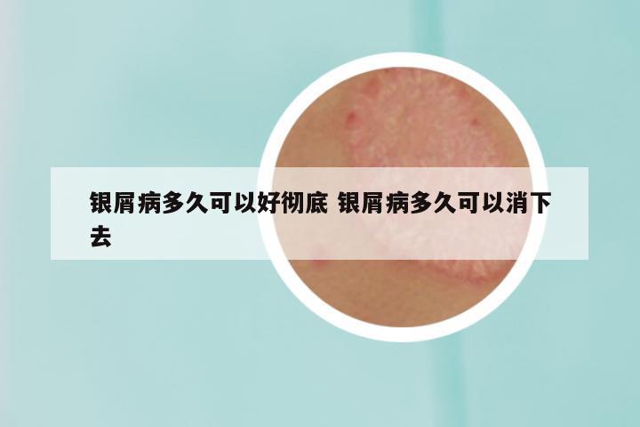 银屑病多久可以好彻底 银屑病多久可以消下去