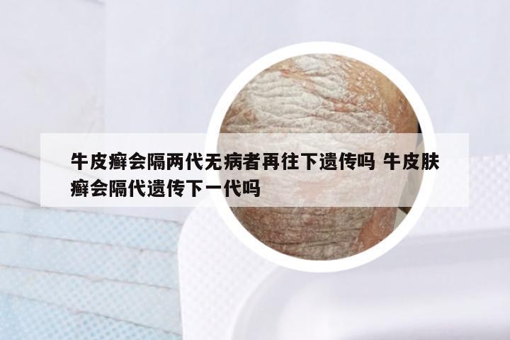 牛皮癣会隔两代无病者再往下遗传吗 牛皮肤癣会隔代遗传下一代吗