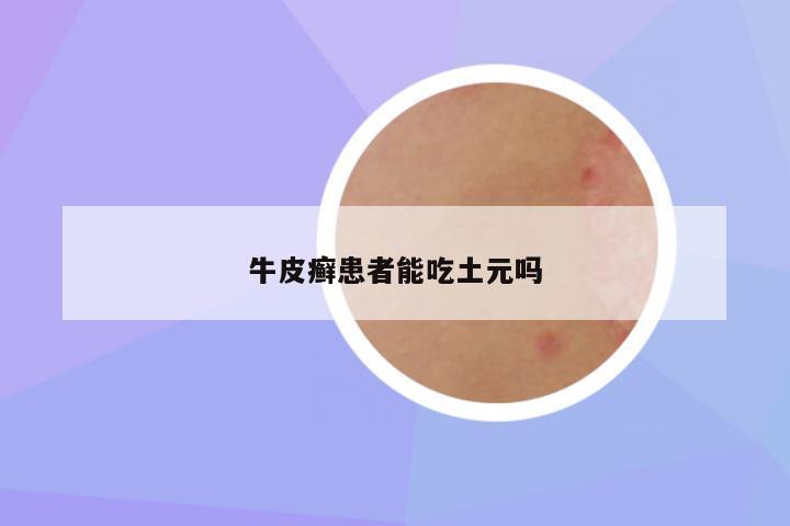 牛皮癣患者能吃土元吗