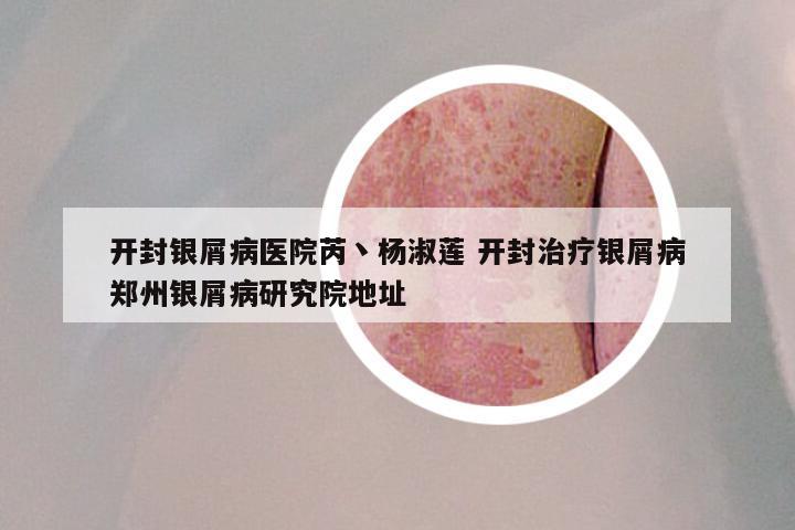 开封银屑病医院芮丶杨淑莲 开封治疗银屑病郑州银屑病研究院地址
