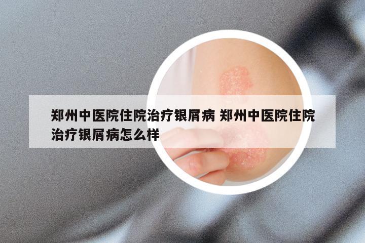 郑州中医院住院治疗银屑病 郑州中医院住院治疗银屑病怎么样