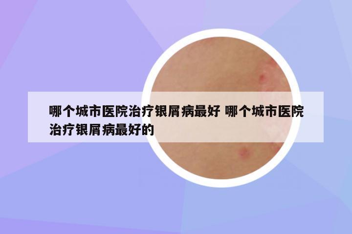 哪个城市医院治疗银屑病最好 哪个城市医院治疗银屑病最好的