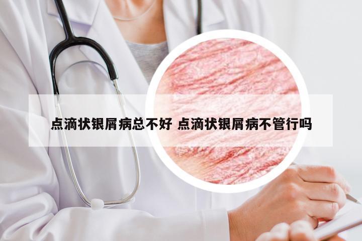 点滴状银屑病总不好 点滴状银屑病不管行吗