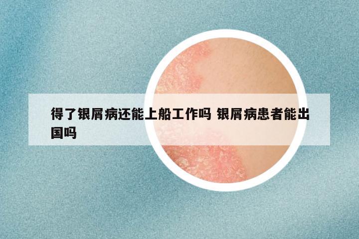 得了银屑病还能上船工作吗 银屑病患者能出国吗