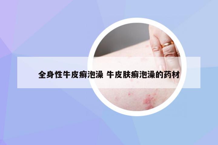 全身性牛皮癣泡澡 牛皮肤癣泡澡的药材