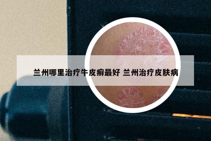 兰州哪里治疗牛皮癣最好 兰州治疗皮肤病