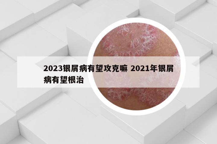2023银屑病有望攻克嘛 2021年银屑病有望根治