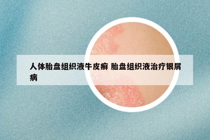 人体胎盘组织液牛皮癣 胎盘组织液治疗银屑病