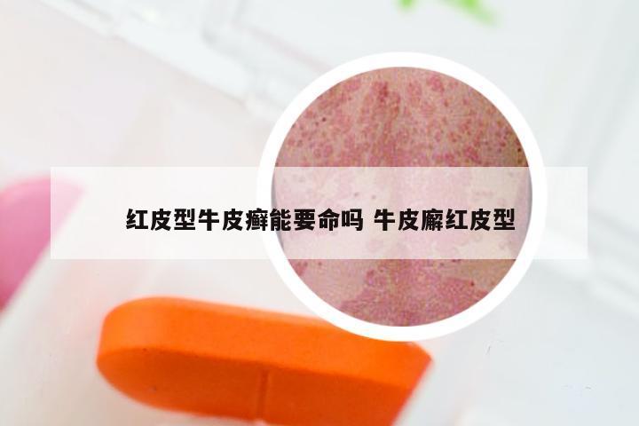 红皮型牛皮癣能要命吗 牛皮廨红皮型