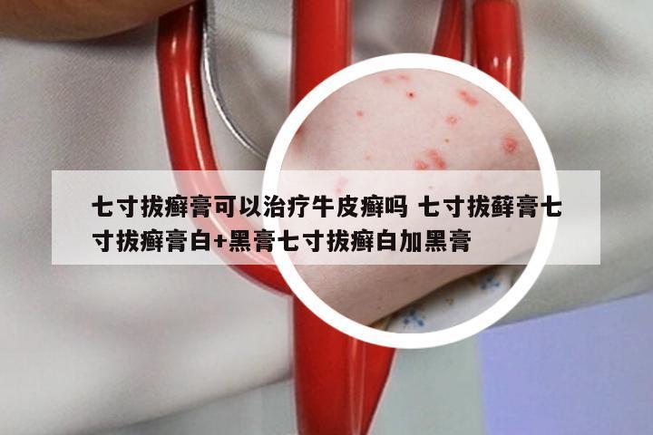 七寸拔癣膏可以治疗牛皮癣吗 七寸拔藓膏七寸拔癣膏白+黑膏七寸拔癣白加黑膏