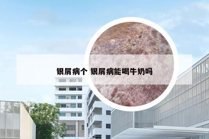 银屑病个 银屑病能喝牛奶吗