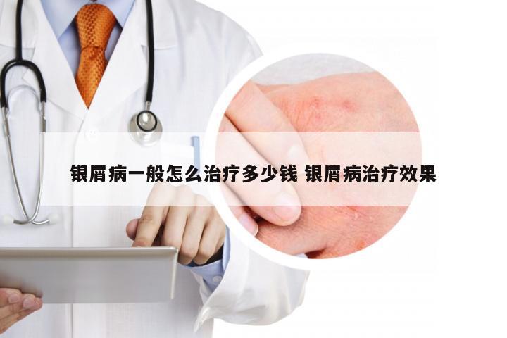 银屑病一般怎么治疗多少钱 银屑病治疗效果