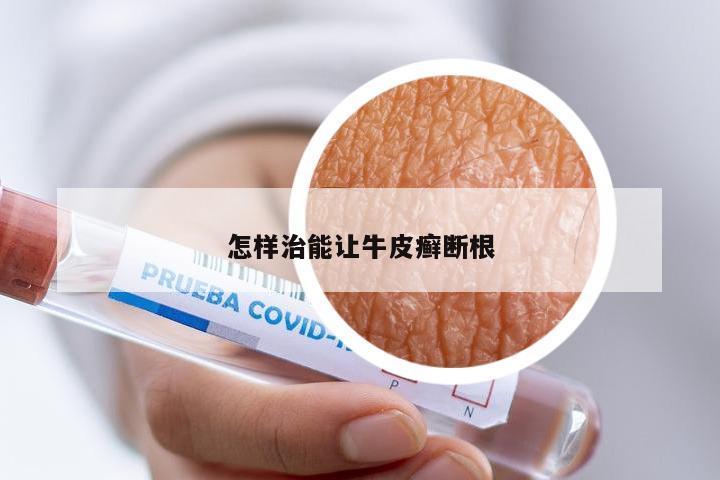 怎样治能让牛皮癣断根