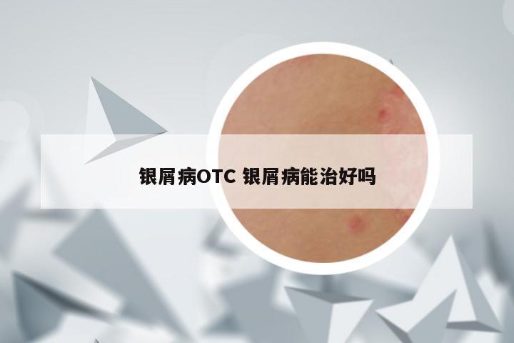 银屑病OTC 银屑病能治好吗