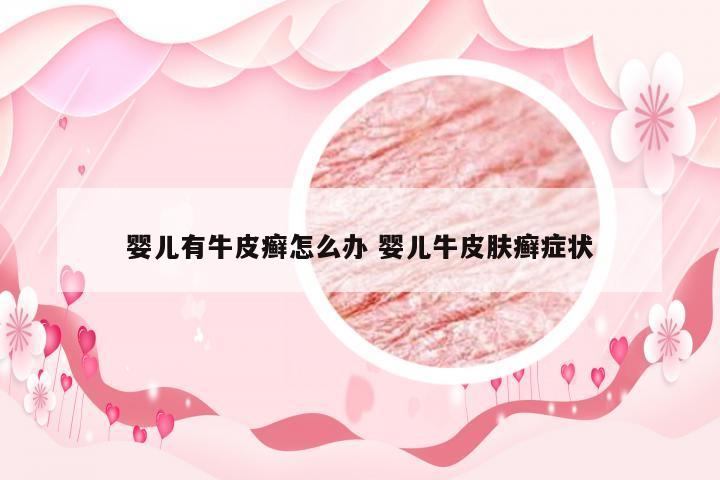 婴儿有牛皮癣怎么办 婴儿牛皮肤癣症状