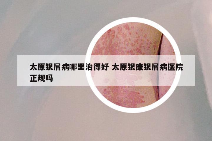 太原银屑病哪里治得好 太原银康银屑病医院正规吗