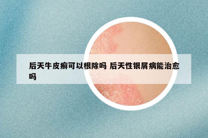 后天牛皮癣可以根除吗 后天性银屑病能治愈吗